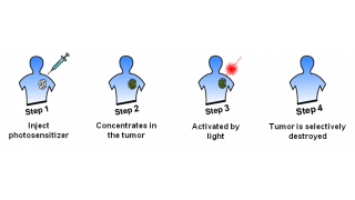 Photodynamic therapy (PDT)